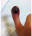 Rare Rapidly Growing Thumb Lesion in a 12-Year-Old Male 2 Creative Commons images