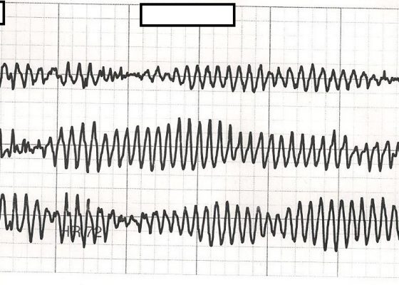 Torsades de Pointes 8 Creative Commons images