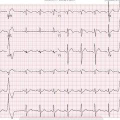 Type 1 Brugada Syndrome 8 Creative Commons images