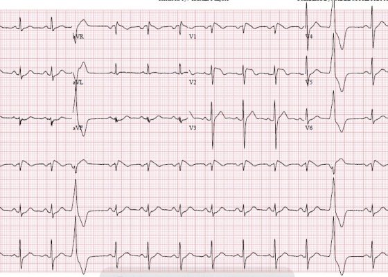 Type 1 Brugada Syndrome 10 Creative Commons images