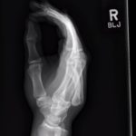 Dorsally-Displaced Metacarpal Dislocation-Fracture 4 Creative Commons images