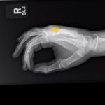 Dorsally-Displaced Metacarpal Dislocation-Fracture 8 Creative Commons images