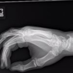 Dorsally-Displaced Metacarpal Dislocation-Fracture 10 Creative Commons images