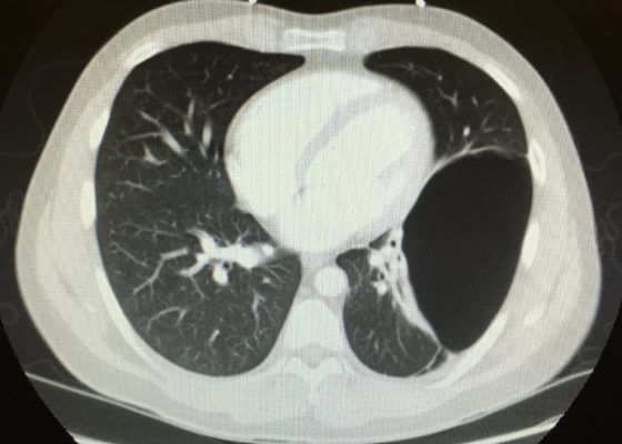 Bullous Emphysema 16 Creative Commons images