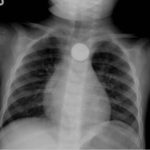 Button Battery in Esophagus 1 Creative Commons images