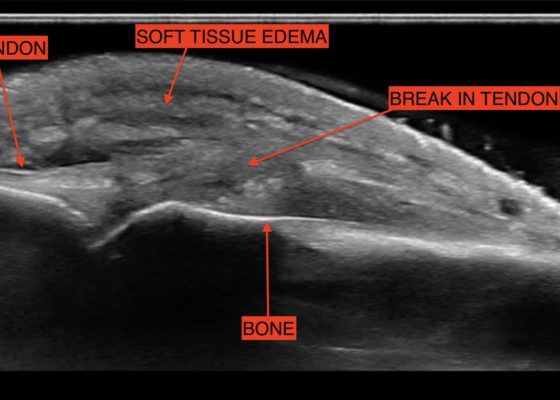 Fight Bite with Tendon Laceration 14 Creative Commons images
