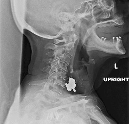 Woman Swallows a “Handful of Pills” 12 Creative Commons images