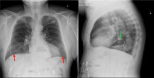 Incidental Hiatal Hernia on Chest X-ray 1 Creative Commons images