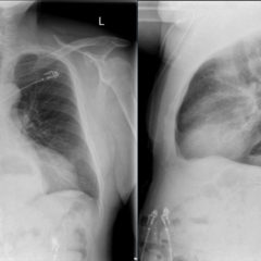 Incidental Hiatal Hernia on Chest X-ray 4 Creative Commons images
