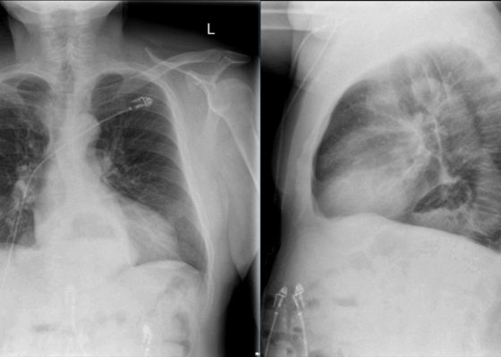 Incidental Hiatal Hernia on Chest X-ray 14 Creative Commons images