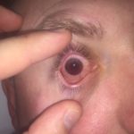 Traumatic Hyphema 3 Creative Commons images