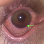 Traumatic Hyphema 2 Creative Commons images
