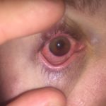 Traumatic Hyphema 4 Creative Commons images