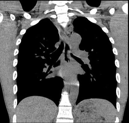 Acute Dysphagia in a 25-Year-Old Male 10 Creative Commons images