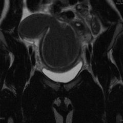 A Rare Cause of Pelvic Pain in a Teenage Girl 8 Creative Commons images