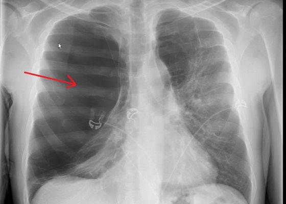The Role of Chest X-Ray and Bedside Ultrasound in Diagnosing Pulmonary Bleb versus Pneumothorax 2 Creative Commons images