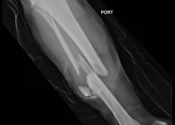 Bilateral Tibia/Fibula Fractures in Automobile versus Pedestrian Accident 16 Creative Commons images
