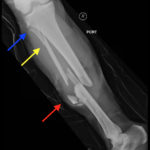 Bilateral Tibia/Fibula Fractures in Automobile versus Pedestrian Accident 1 Creative Commons images
