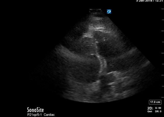 Right Ventricular Dilation in Patient With Submassive Pulmonary Embolism 4 Creative Commons images