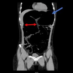 Recurrent Sigmoid Volvulus in a Young Female 7 Creative Commons images