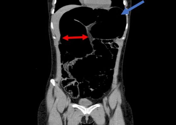 Recurrent Sigmoid Volvulus in a Young Female 8 Creative Commons images