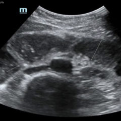 Point of Care Ultrasound Illustrating Small Bowel Obstruction 8 Creative Commons images