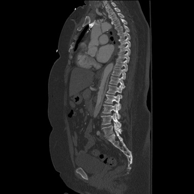 Extensive Aortic Dissection with Normal Vital Signs 12 Creative Commons images