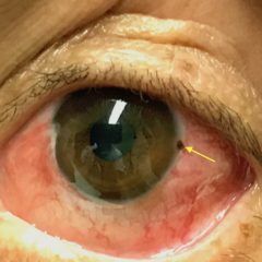 Corneal Rust Ring 8 Creative Commons images