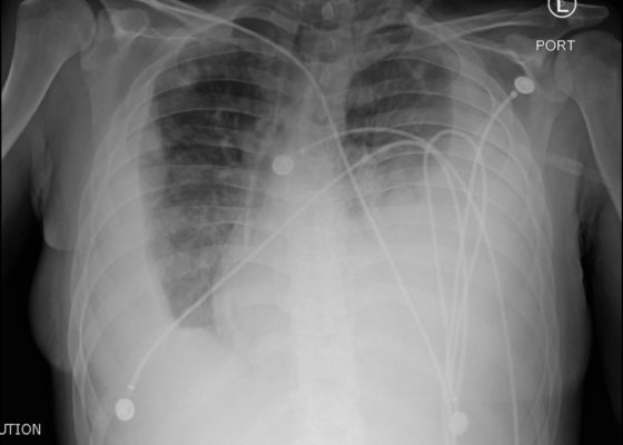 Endocarditis 6 Creative Commons images