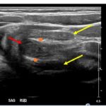 Brief Review of Intussusception Diagnosis and Management 1 Creative Commons images