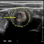 Brief Review of Intussusception Diagnosis and Management 2 Creative Commons images