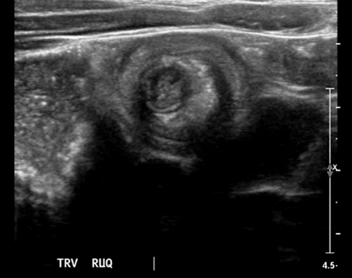 Brief Review of Intussusception Diagnosis and Management 4 Creative Commons images