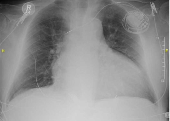 Don’t Forget the Pacemaker - A Rare Complication 2 Creative Commons images