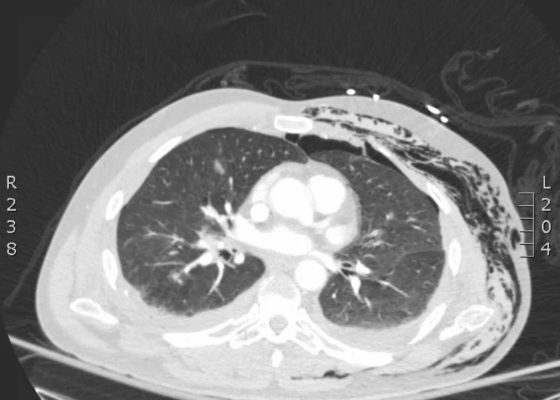 Subcutaneous Emphysema After Chest Trauma 16 Creative Commons images
