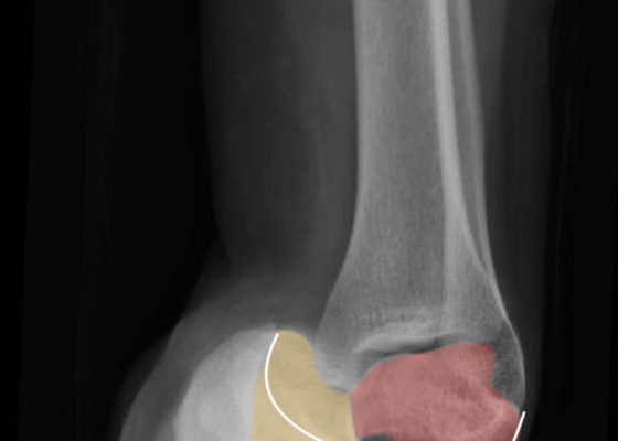 Talonavicular Dislocation 12 Creative Commons images