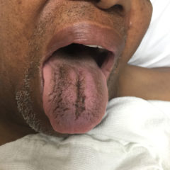 Abdominal Pain with Black Tongue 7 Creative Commons images