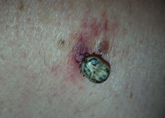 Tick Removal 10 Creative Commons images