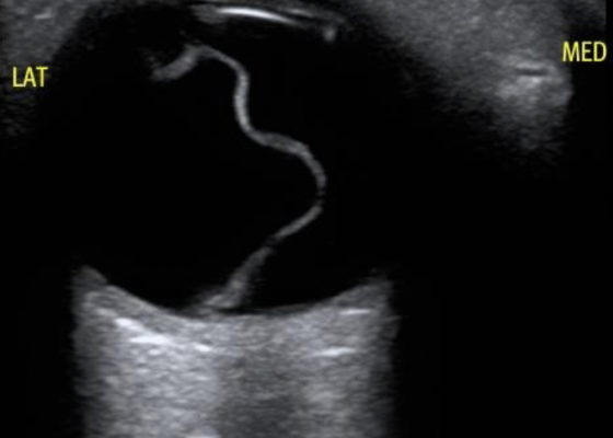Macula-Off Retinal Detachment Identified on Bedside Ultrasound 2 Creative Commons images
