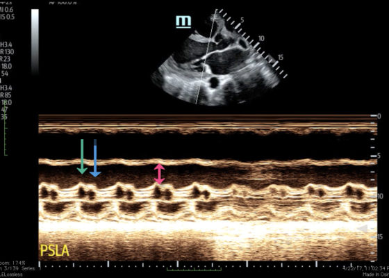 Point-of-Care Ultrasound for the Diagnosis of Systolic Heart Failure 8 Creative Commons images