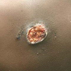 Suspicious Skin Lesion in an 11-Year-Old Male 8 Creative Commons images