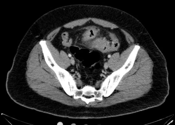 Sigmoid Diverticulitis Complicated by Colovesical Fistula Presenting with Pneumaturia 2 Creative Commons images