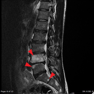 Erectile Dysfunction as a Presenting Symptom for Renal Cell Carcinoma 14 Creative Commons images