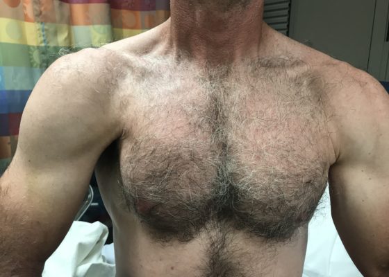 Pectoralis Muscle Tendon Rupture 6 Creative Commons images