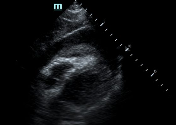 Pericardial Clot on Point-of-Care Ultrasound 12 Creative Commons images