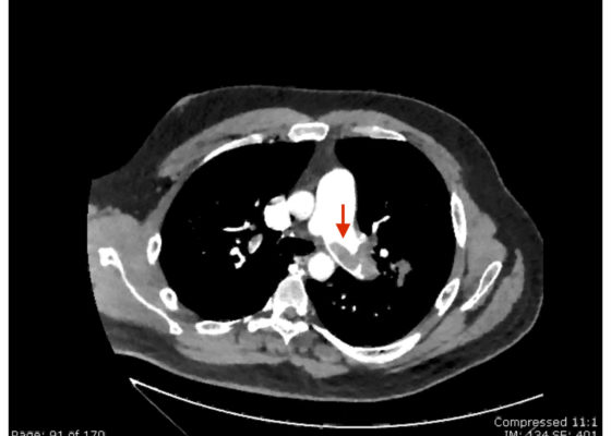 Saddle Pulmonary Embolus 10 Creative Commons images