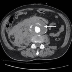 Ruptured AAA Presenting with Unresponsiveness and Cardiac Arrest 5 Creative Commons images