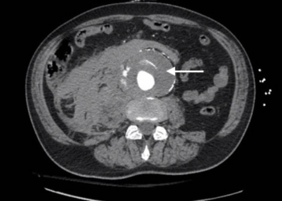 Ruptured AAA Presenting with Unresponsiveness and Cardiac Arrest 2 Creative Commons images