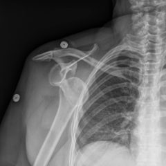 Diagnosis and Treatment of an Anterior Shoulder Dislocation with Bedside Ultrasound 10 Creative Commons images