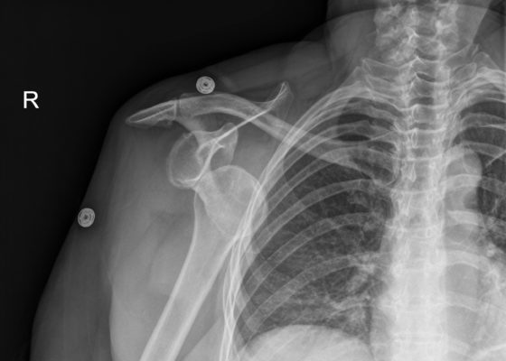 Diagnosis and Treatment of an Anterior Shoulder Dislocation with Bedside Ultrasound 4 Creative Commons images