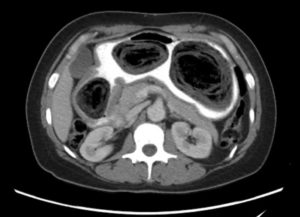 Bezoars: An Interesting Case of Abdominal Pain 4 Creative Commons images